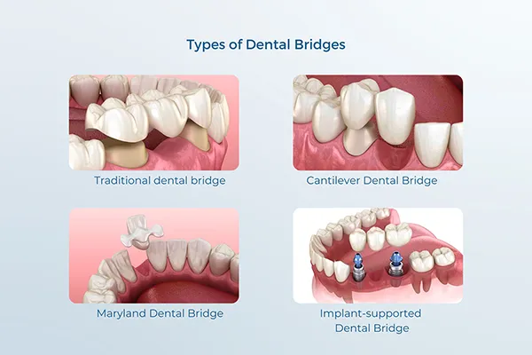 Dental Bridges
